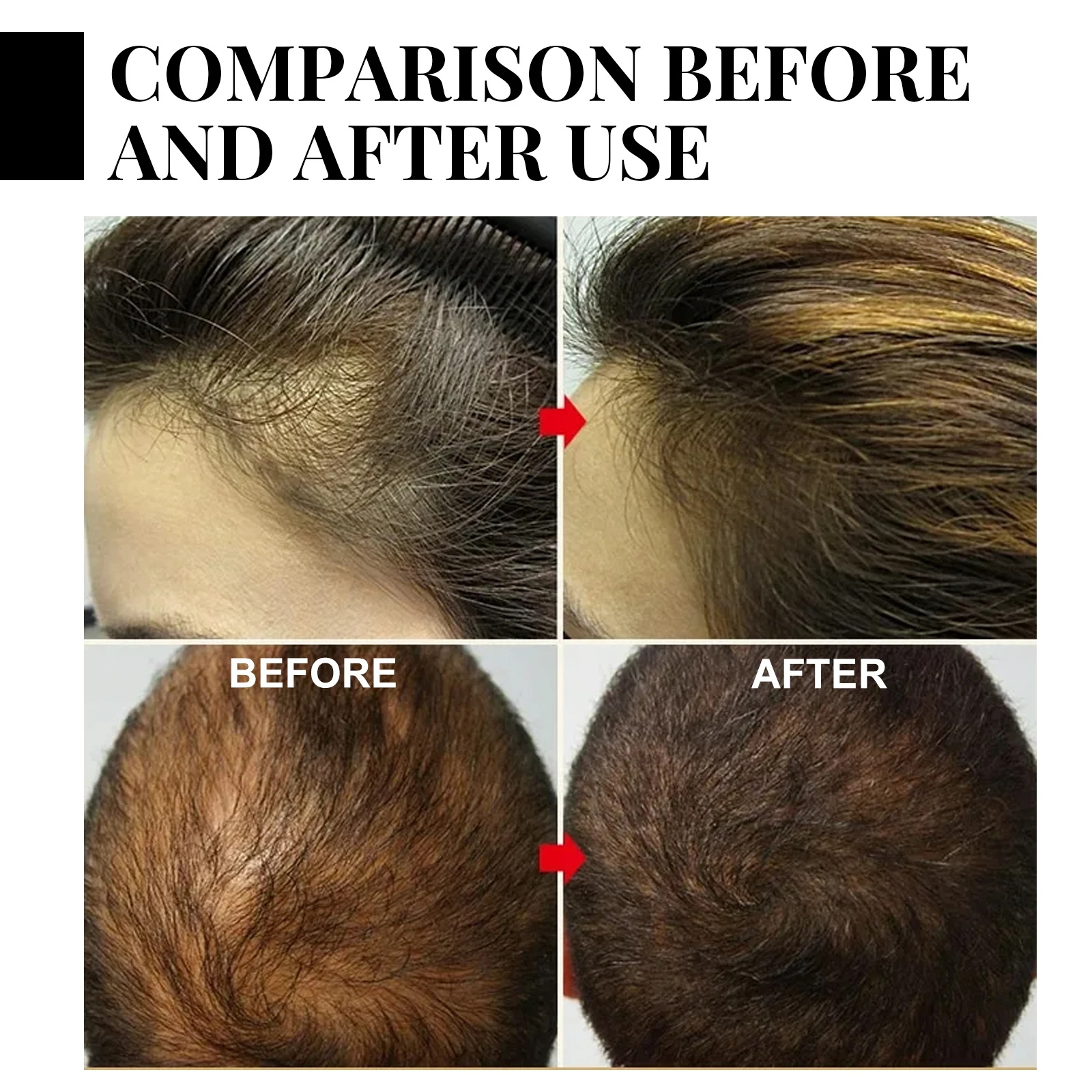 Ginger Hair Growth spray Anti  - Hair Growth Serum Oil recension och pris